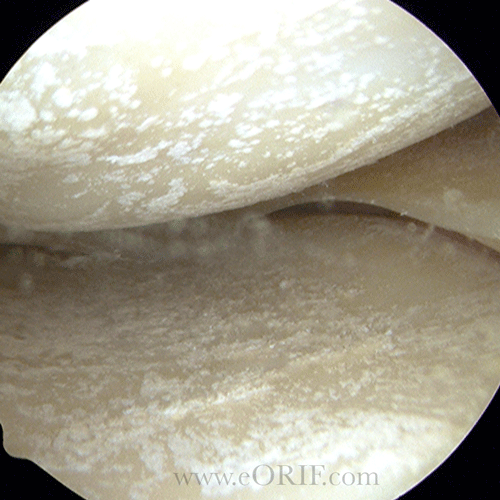 CPPD of the knee arthroscopic image