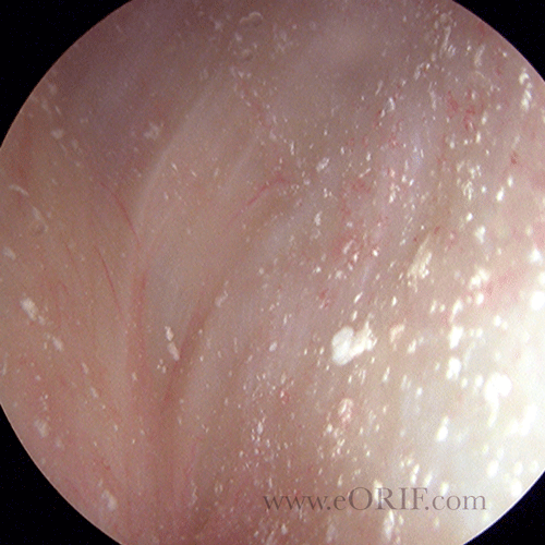 CPPD of the knee arthroscopic image