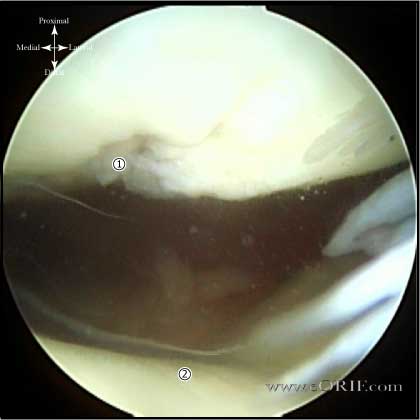 chondral grade classification facet icrs medial cartilage injury eorif patella depth fissuring fragmentation