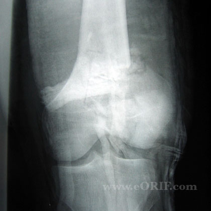 Supracondylar femur fracture xray