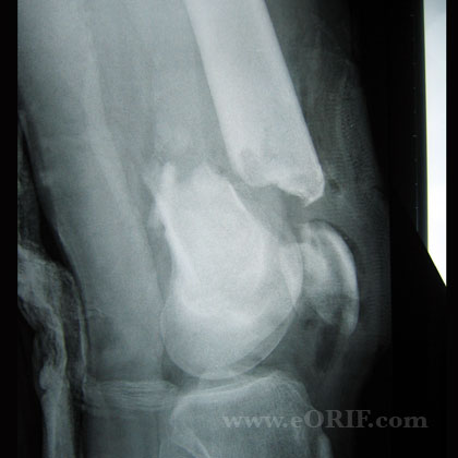 Supracondylar femur fracture xray