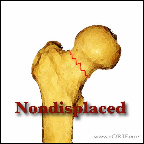 Nondisplaced femoral neck fracture image