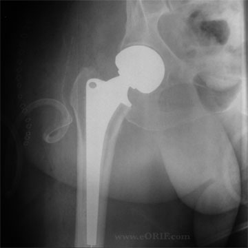 left femoral neck fracture