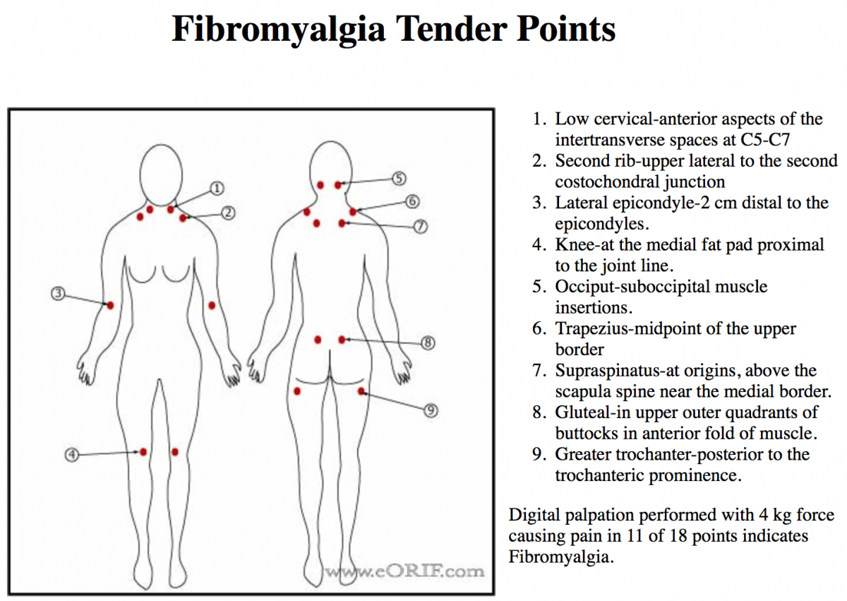 Фибромиалгия точки триггеры фото