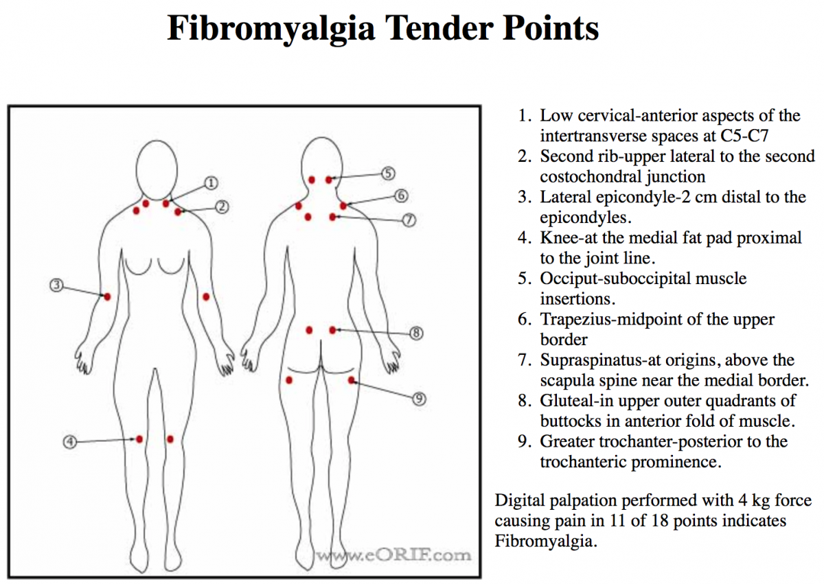 Болезненные точки при фибромиалгии фото