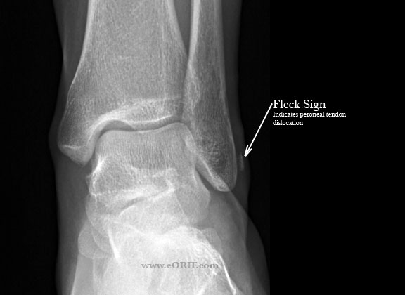 lateral malleolus fracture icd10