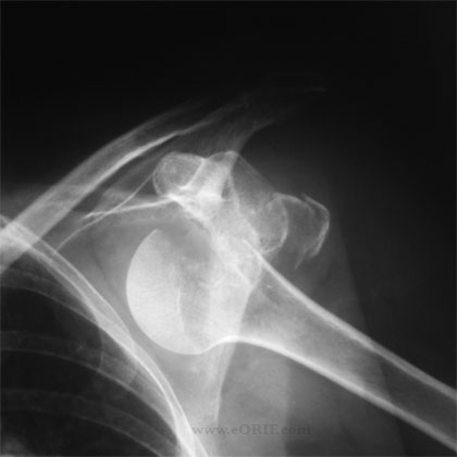 Greater Tuberosity Fracture S42.253A 812.03 | eORIF