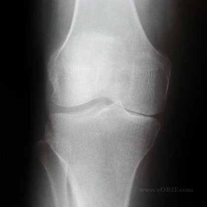 knee arthritis xray