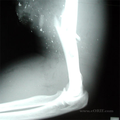 Humeral shaft fracture gun shot X-ray