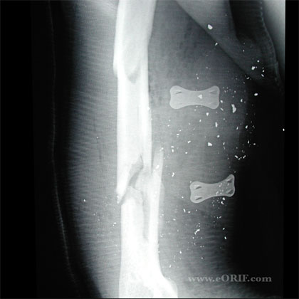 Humeral shaft fracture xray