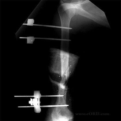 Humeral shaft fracture external fixation