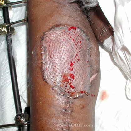 gun shot wound skin graft