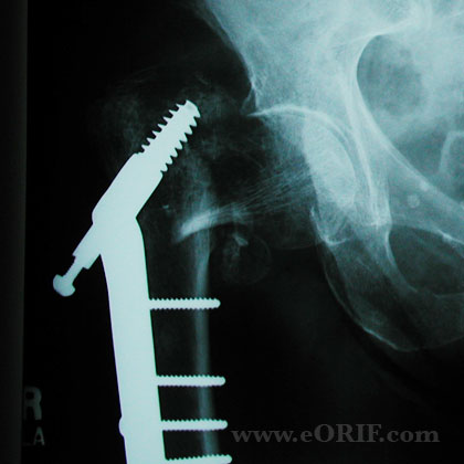 Intertrochanteric femur fracture DHS failure