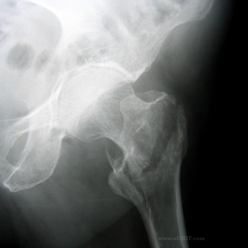 intertrochanteric fracture left hip icd 10