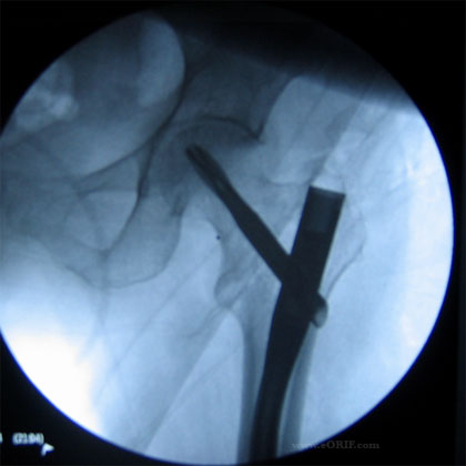 IMHS intertrochanteric hip fracture xray