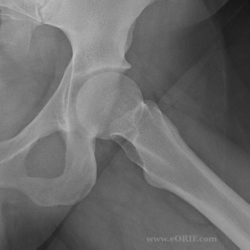 Lateral xray view of the hip