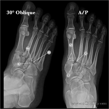 lisfranc injury icd 10 code