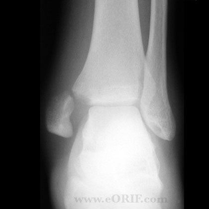 cpt code for closed treatment of lateral malleolus fracture