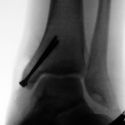 icd 10 lateral malleolus fracture