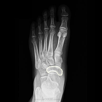 navicular foot bone xray