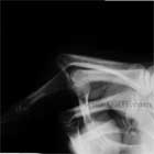 PIP joint dislocation xray