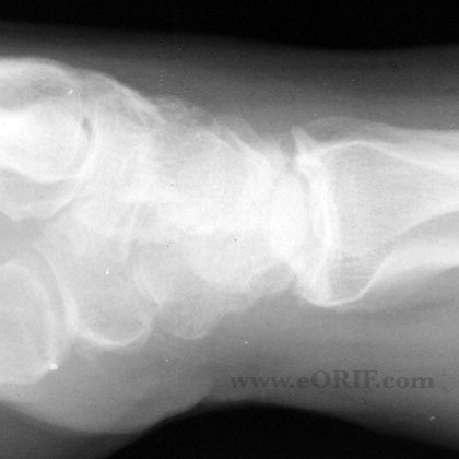 Wrist arthritis lateral view xray