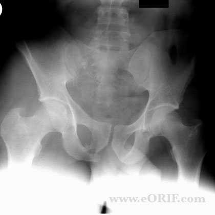 Pelvic Fractures:Low Impact - Physiopedia