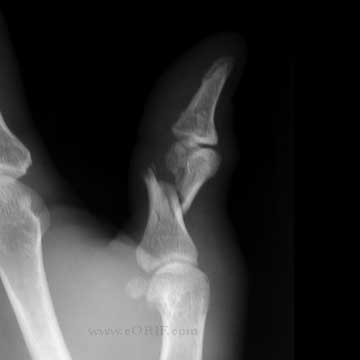Thumb proximal phalanx fracture xray