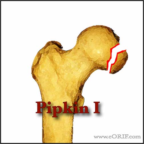 Pipkin Type 1 femoral head fracture image