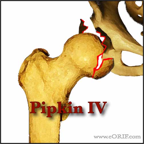 Pipkin Type IV femoral head fracture image