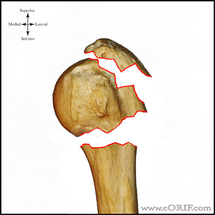 Proximal Humerus Fracture Classification Eorif