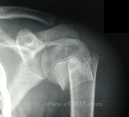 Pediatric proximal humerus fracture xray