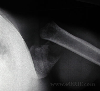 Pediatric proximal humerus fracture lateral xray