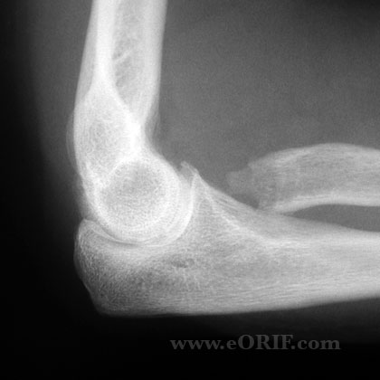 Radial Head Fracture excision xray