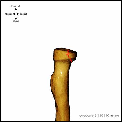 Radial Head Fracture Classification | eORIF