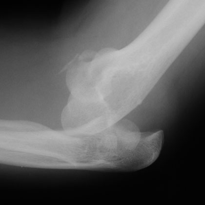 type IV radial head fracture