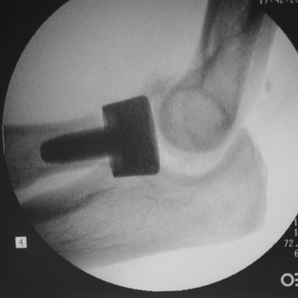 radial head replacement xray