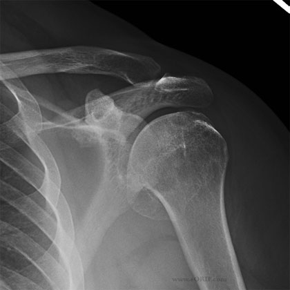 shoulder arthritis xray