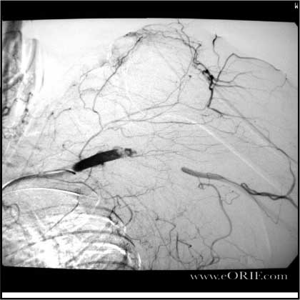 axillary artery injury picture