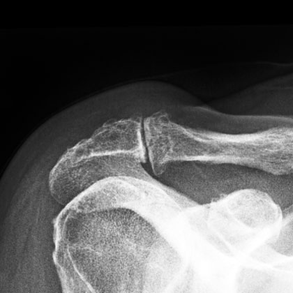 AC arthritis xray