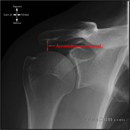 Acromiohumeral Interval