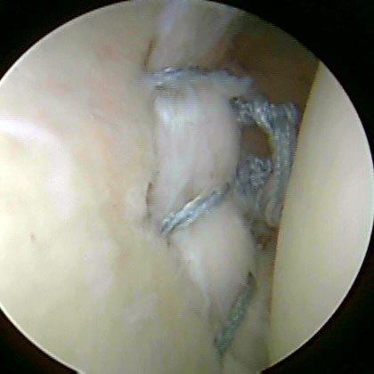 bankart lesion repair