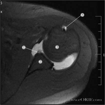 Bankart lesion mri