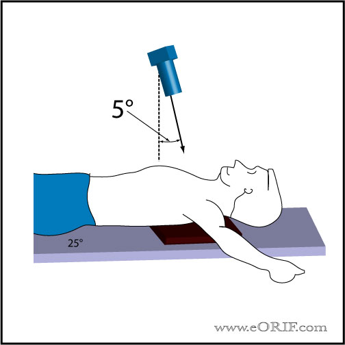 Bennett's view Shoulder Xray