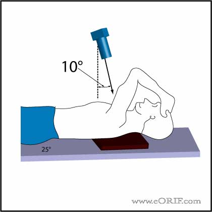 Stryker Notch View Shoulder Xray