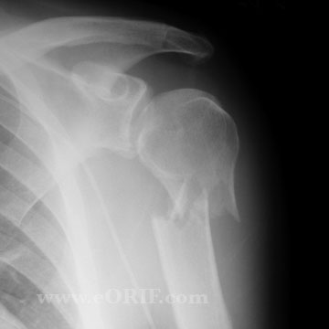 Proximal Humerus Fracture xray