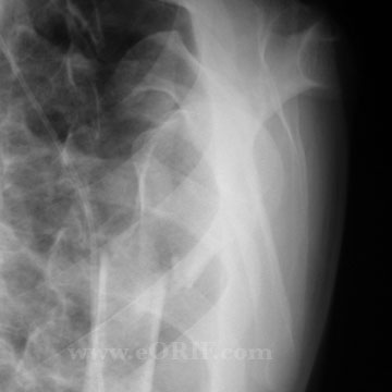 Proximal Humerus Fracture xray
