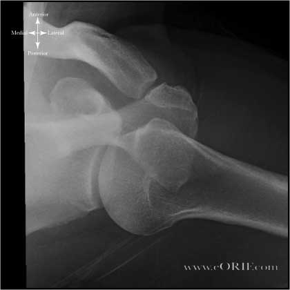 Axillary view Shoulder Xray