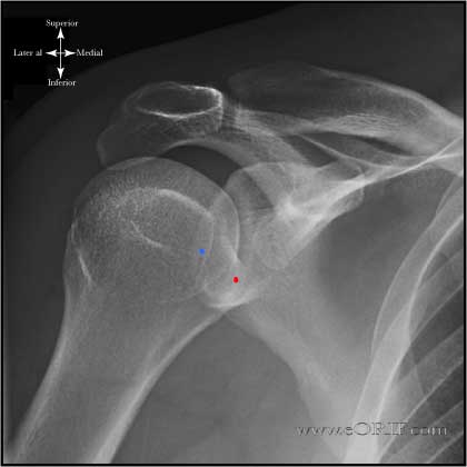 AP Shoulder in Internal rotation xray