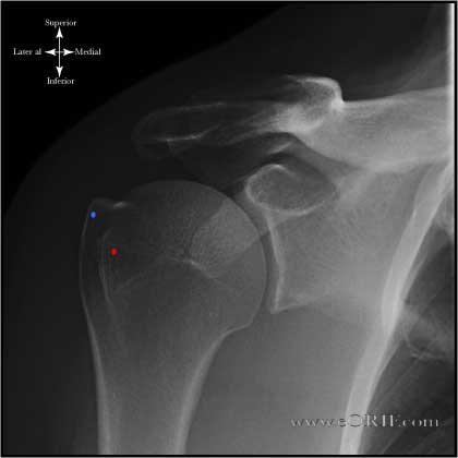 True AP Shoulder in neutral rotation 